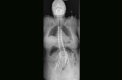 An X-ray shows the effects of surgery and instrumentation to straighten a severely curved spine.